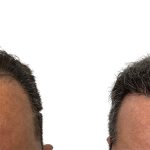 Hair Transplants Before & After Patient #762