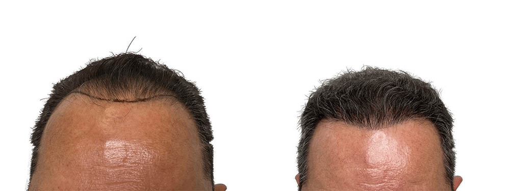 Hair Transplants Before & After Patient #762