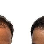 Hair Transplants Before & After Patient #769