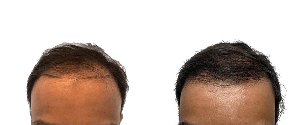 Hair Transplants Before & After Patient #769