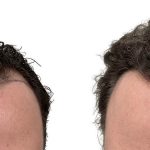 Hair Transplants Before & After Patient #773