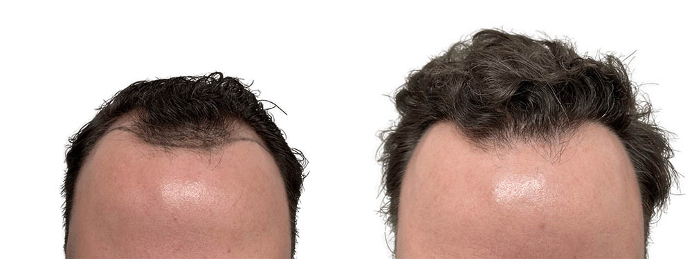 Hair Transplants Before & After Patient #773