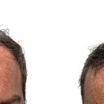 Hair Transplants Before & After Patient #778