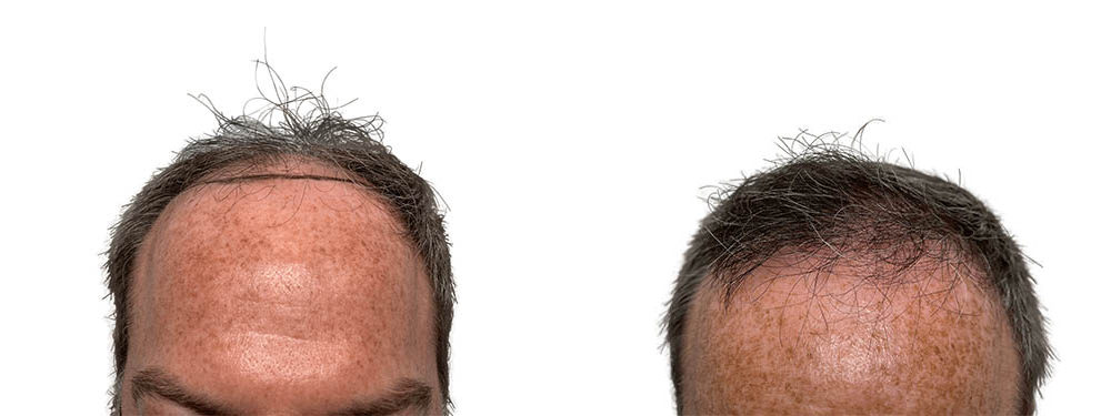 Hair Transplants Before & After Patient #778
