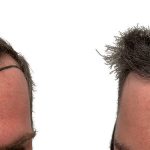 Hair Transplants Before & After Patient #782