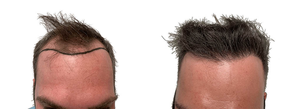 Hair Transplants Before & After Patient #782