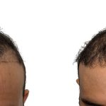 Hair Transplants Before & After Patient #786