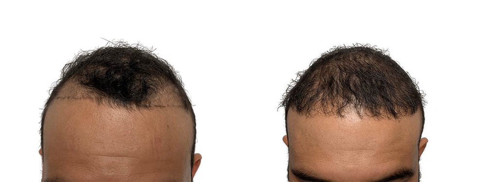 Hair Transplants Before & After Patient #786
