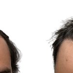 Hair Transplants Before & After Patient #790