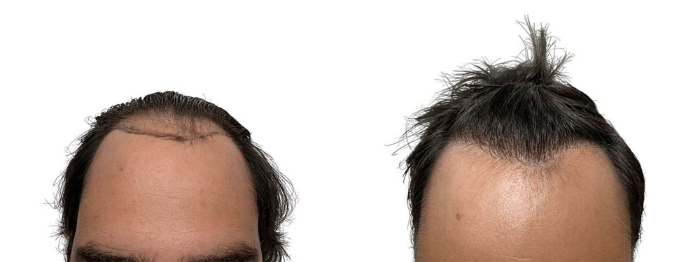 Hair Transplants Before & After Patient #790