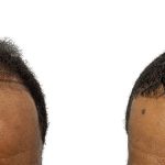 Hair Transplants Before & After Patient #661