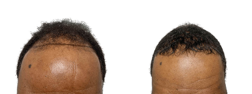 Hair Transplants Before & After Patient #661