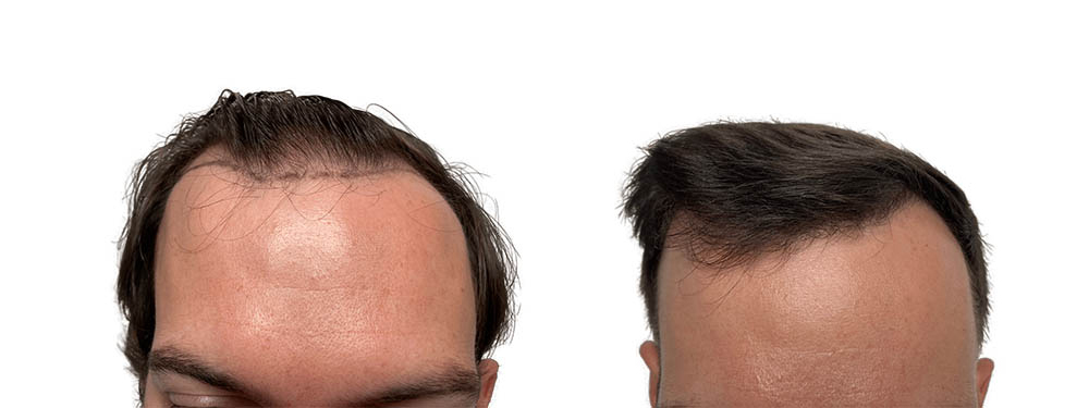 Hair Transplants Before & After Patient #666