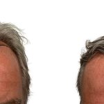 Hair Transplants Before & After Patient #667