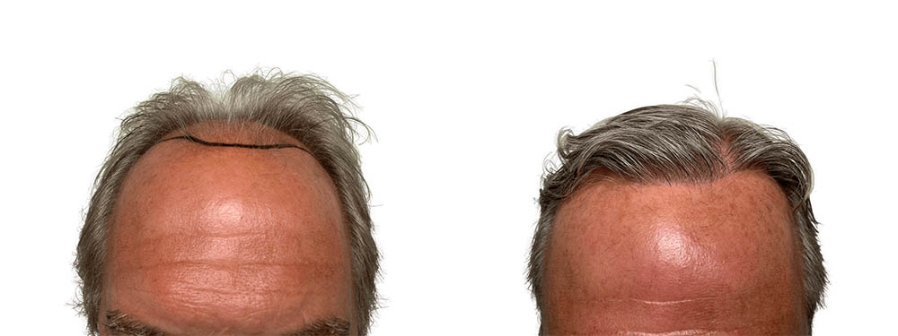 Hair Transplants Before & After Patient #667