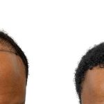 Hair Transplants Before & After Patient #668