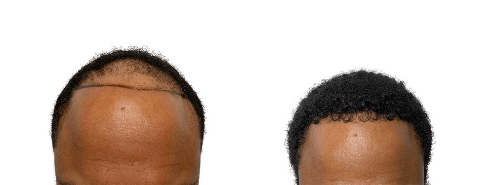 Hair Transplants Before & After Patient #668