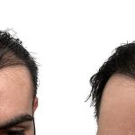 Hair Transplants Before & After Patient #687
