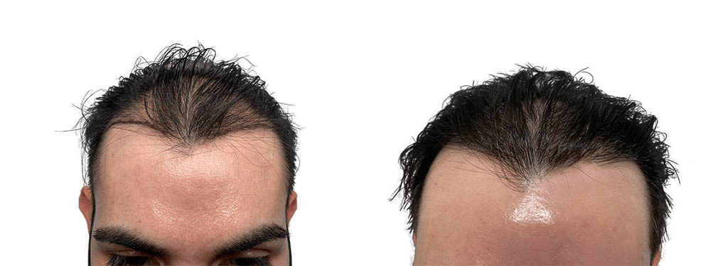 Hair Transplants Before & After Patient #687