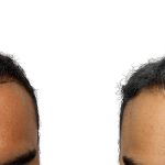 Hair Transplants Before & After Patient #688