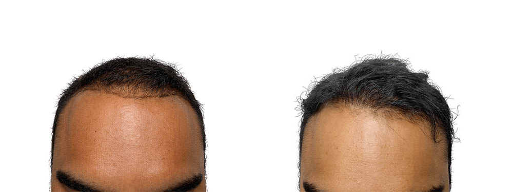 Hair Transplants Before & After Patient #688