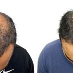 Hair Transplants Before & After Patient #688