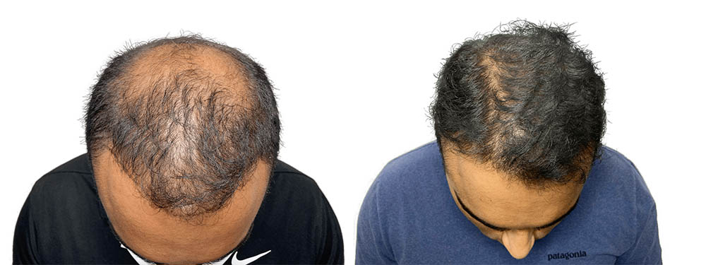 Hair Transplants Before & After Patient #688