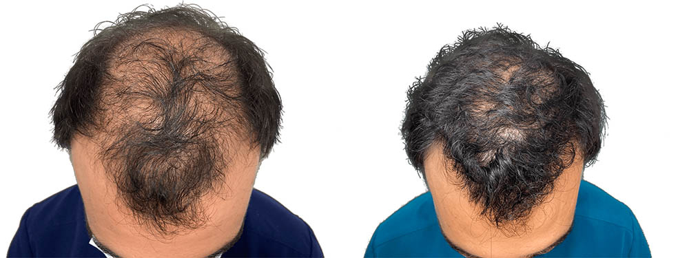 Hair Transplants Before & After Patient #694