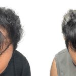 Hair Transplants Before & After Patient #704