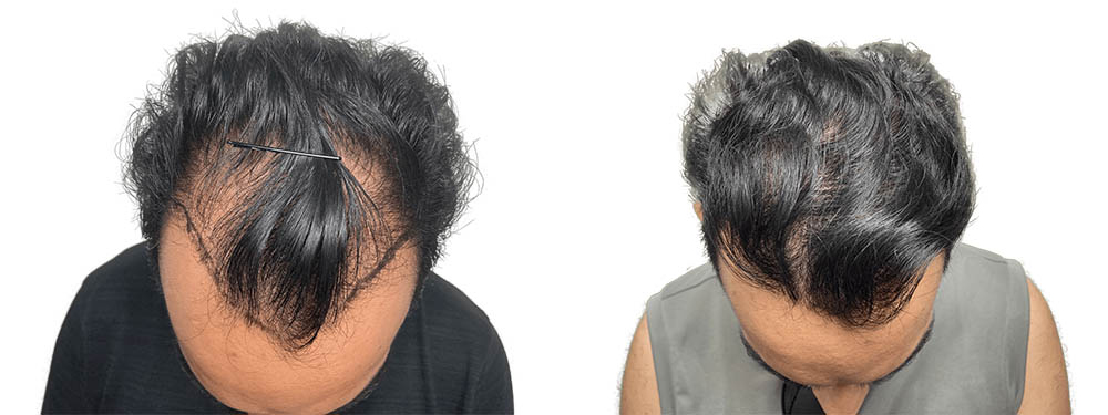 Hair Transplants Before & After Patient #704