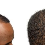 Hair Transplants Before & After Patient #709