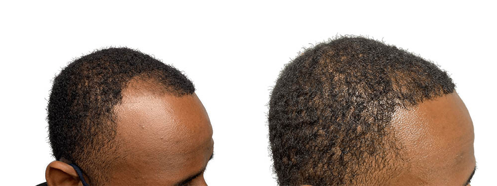 Hair Transplants Before & After Patient #709
