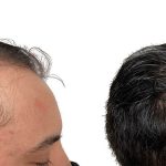 Hair Transplants Before & After Patient #714