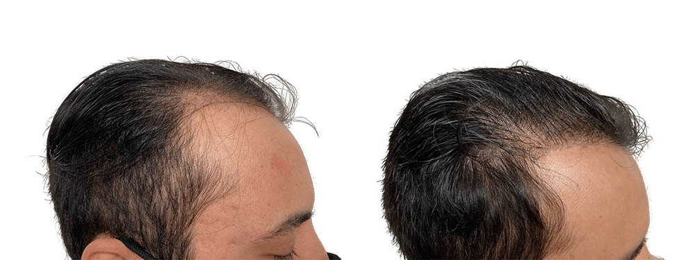 Hair Transplants Before & After Patient #714