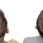 Hair Transplants Before & After Patient #719