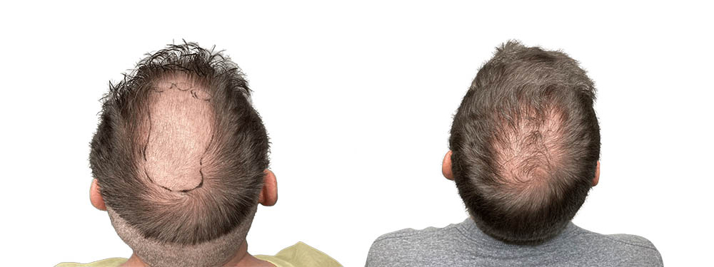 Hair Transplants Before & After Patient #719