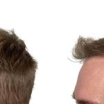 Hair Transplants Before & After Patient #723