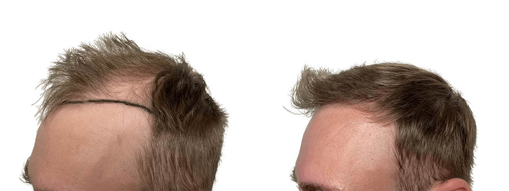 Hair Transplants Before & After Patient #723