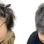 Hair Transplants Before & After Patient #728