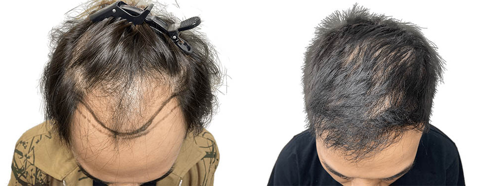 Hair Transplants Before & After Patient #728