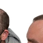 Hair Transplants Before & After Patient #733