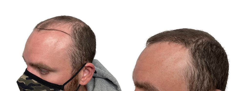 Hair Transplants Before & After Patient #733