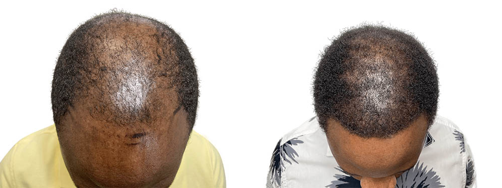 Hair Transplants Before & After Patient #743