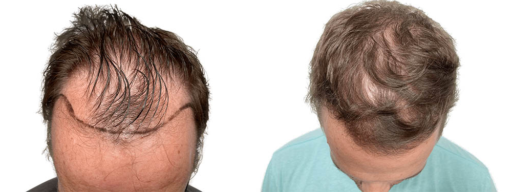 Hair Transplants Before & After Patient #748