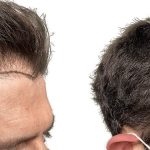 Hair Transplants Before & After Patient #753