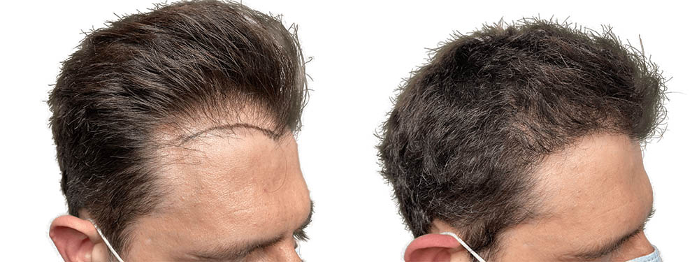 Hair Transplants Before & After Patient #753