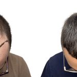 Hair Transplants Before & After Patient #757