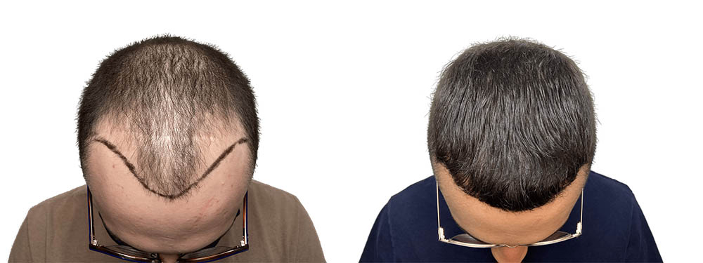Hair Transplants Before & After Patient #757