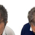 Hair Transplants Before & After Patient #762