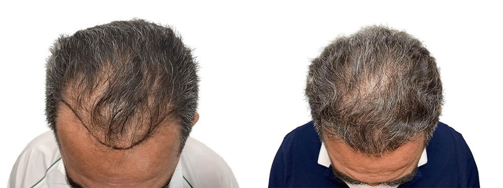 Hair Transplants Before & After Patient #762